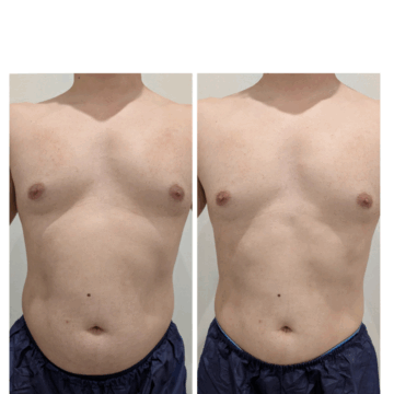 t.k様お腹痩身BeforeAfter（正面）