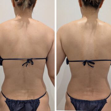 背面BeforeAfter。背中全体がスッキリして腰回りも引き締まりました。