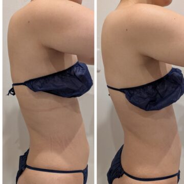 お腹周りBeforeAfter。お腹・腰回りがスッキリした結果に。