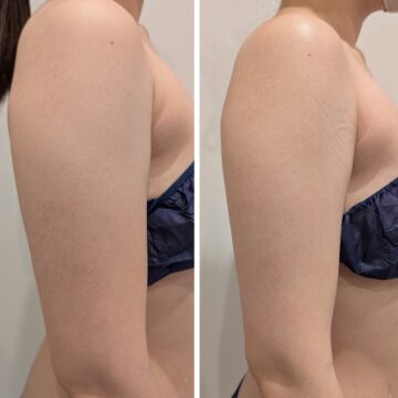 二の腕痩身BeforeAfter。二の腕がスッキリしてラインが綺麗に。