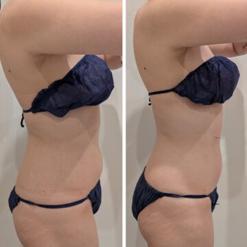 腰回り・お腹のBeforeAfter。腰回りのウエストラインがスッキリして綺麗に。