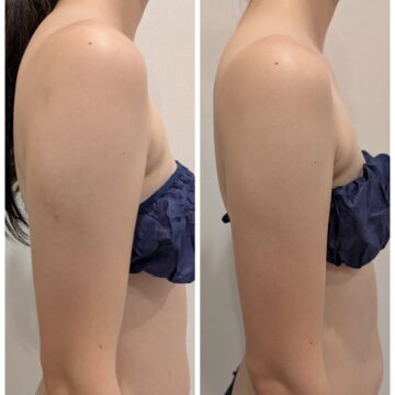 前肩で、首も前へ出がちだったのが、後ろへ戻ったことで、首もより長くスッと伸びた印象。肩上の盛りあがりもなだらかになり、二の腕の見え方が、細見え。