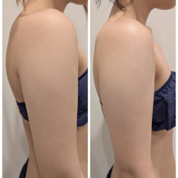二の腕BeforeAfter。二の腕周りがスッキリしてラインが綺麗に。