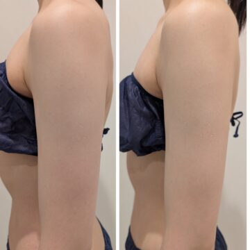 デコルテ・二の腕BeforeAfter。厚みも減ってスッキリ。