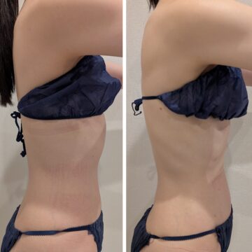 腰回りBeforeAfter。お腹・腰回りがスッキリ